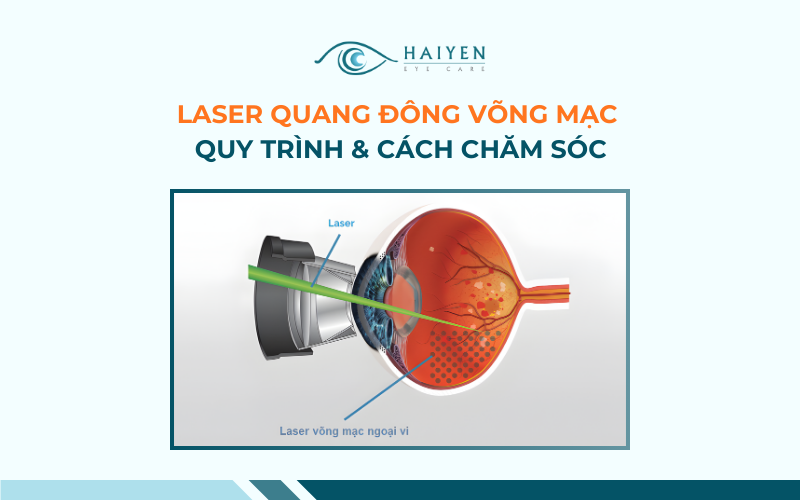 Laser Quang Đông Võng Mạc Giải Pháp Bảo Tồn Thị Lực