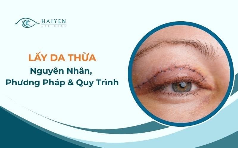 Lấy Da Thừa Mi Mắt: Nguyên Nhân, Phương Pháp & Quy Trình