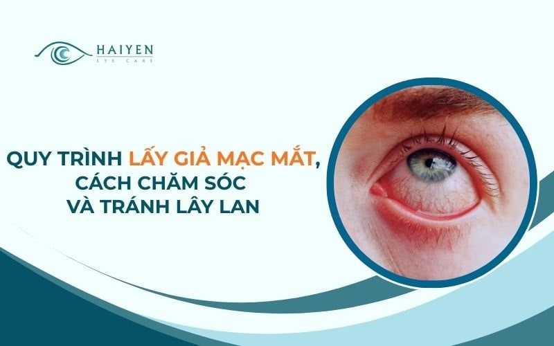 Quy Trình Bóc Giả Mạc Mắt, Cách Chăm Sóc Và Tránh Lây Lan
