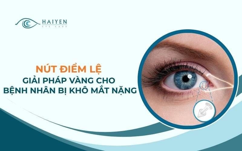 Nút Điểm Lệ: Giải Pháp Vàng Cho Bệnh Nhân Bị Khô Mắt Nặng