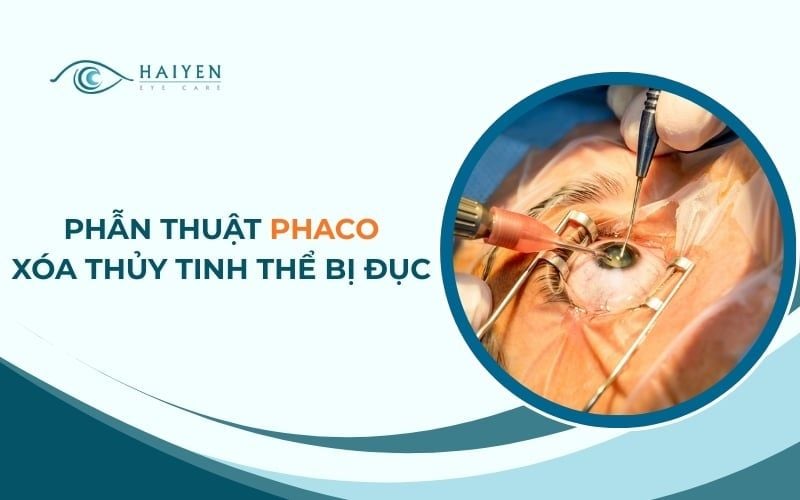Phẫu thuật Phaco là gì? Chuẩn bị, Quy trình thực hiện mổ Phaco