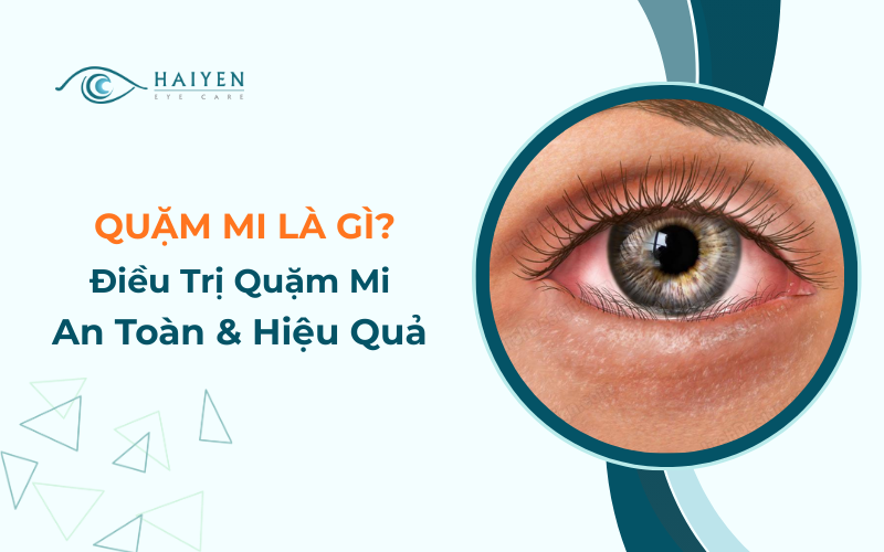 Quặm Mi: Nguyên Nhân, Triệu Chứng & Điều Trị
