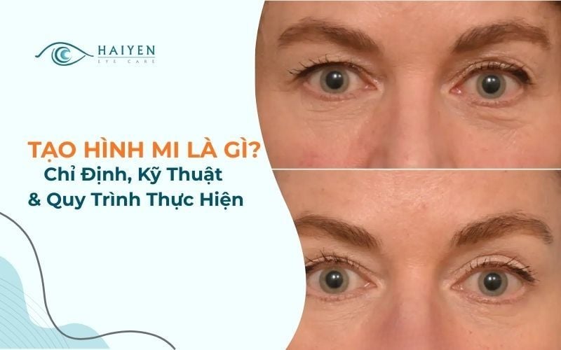 Tạo Hình Mi: Chỉ Định, Kỹ Thuật & Quy Trình Thực Hiện