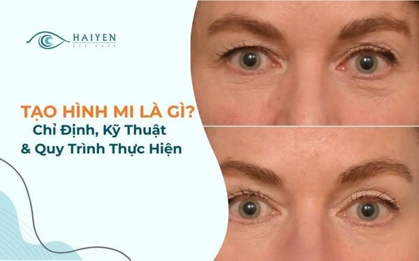 Tạo Hình Mi: Chỉ Định, Kỹ Thuật & Quy Trình Thực Hiện