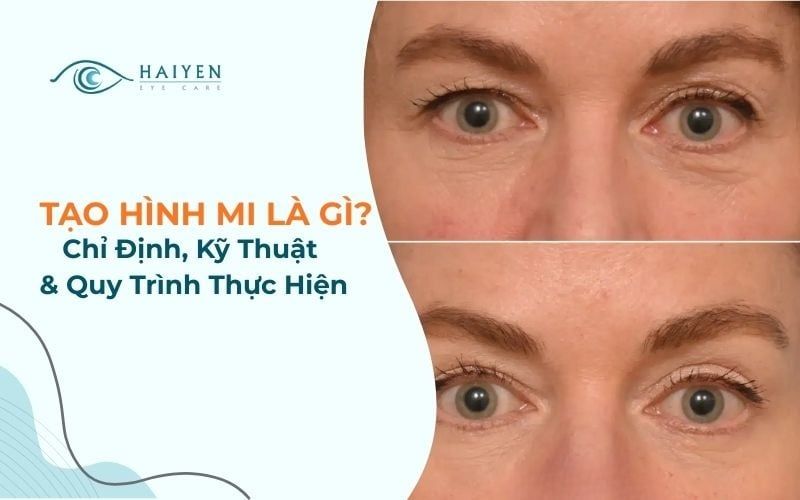 Tạo Hình Mi: Chỉ Định, Kỹ Thuật & Quy Trình Thực Hiện