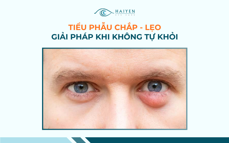 Tìm Hiểu Chắp – Lẹo Mí Mắt: Dấu Hiệu, Nguyên Nhân Và Điều Trị