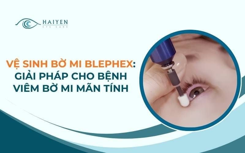 Vệ Sinh Bờ Mi Blephex: Giải Pháp Cho Bệnh Viêm Bờ Mi Mãn Tính