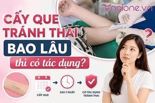 Giải đáp chi tiết: Cấy que tránh thai bao lâu thì có tác dụng?