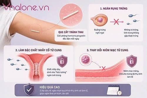 Thắc mắc cấy que tránh thai bao lâu thì có tác dụng?