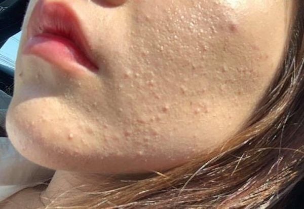 Chăm Sóc Da Dầu Giảm Nhờn: 8 Mẹo Đơn Giản Giúp Da Sạch Thoáng, Hết Mụn