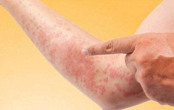 Dị Ứng Hải Sản Có Nguy Hiểm Không? Lời Khuyên Cho Người Dị Ứng Hải Sản