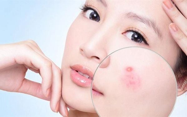 Trị mụn nhọt an toàn: Cách xử lý đúng để tránh nhiễm trùng