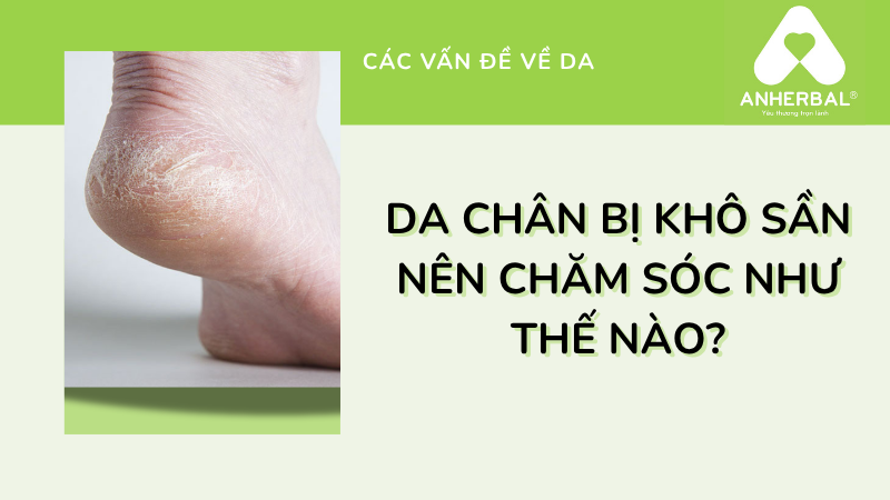 Da chân bị khô sần nên chăm sóc như thế nào?