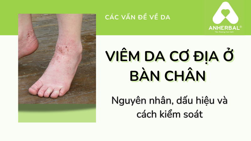 Viêm da cơ địa ở bàn chân: Nguyên nhân, dấu hiệu và cách kiểm soát
