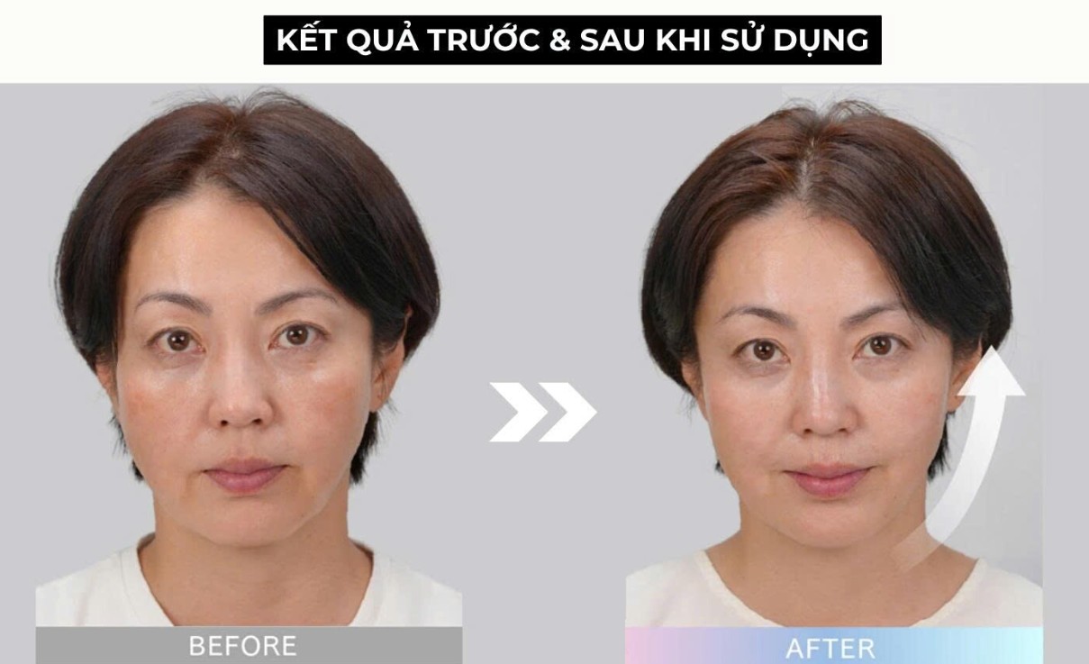 Máy triệt lông Mytrex MiRAY One có Chức năng EMS nâng cơ trước và sau điều trị