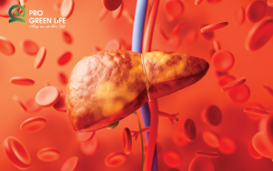 Gan Nhiễm Mỡ - Căn Bệnh Phổ Biến Thời Hiện Đại