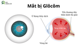 Glôcôm - Thủ phạm âm thầm gây mất thị lực