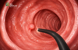 Polyp Dạ Dày: Không Phải Tất Cả Đều Nguy Hiểm, Nhưng Cũng Đừng Chủ Quan