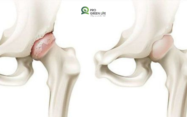 Cơn Đau Khớp Háng Âm Ỉ Và Hậu Quả Không Ai Muốn Đối Mặt