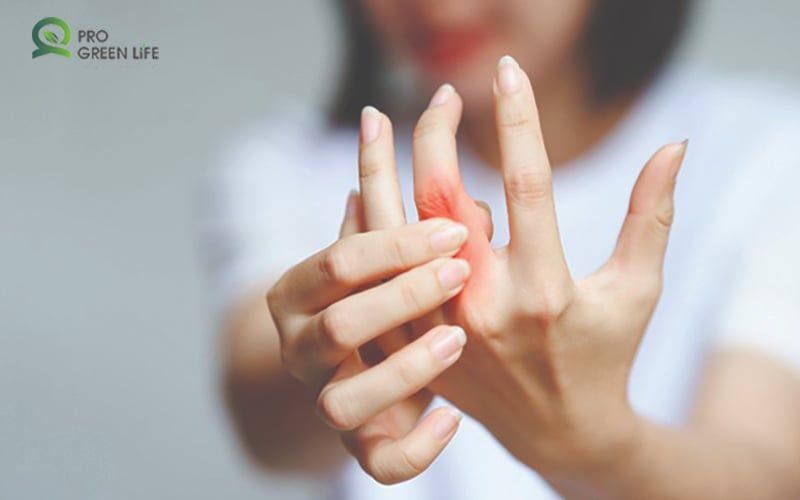 Viêm Khớp Dạng Thấp Ở Phụ Nữ Trẻ - Đôi Tay Chưa Kịp Già, Bệnh Khớp Đã Gõ Cửa