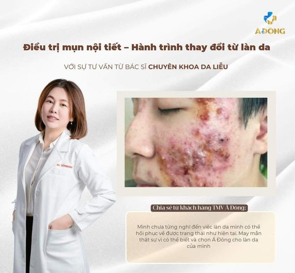 ĐIỀU TRỊ MỤN NỘI TIẾT – HÀNH TRÌNH THAY ĐỔI LÀN DA