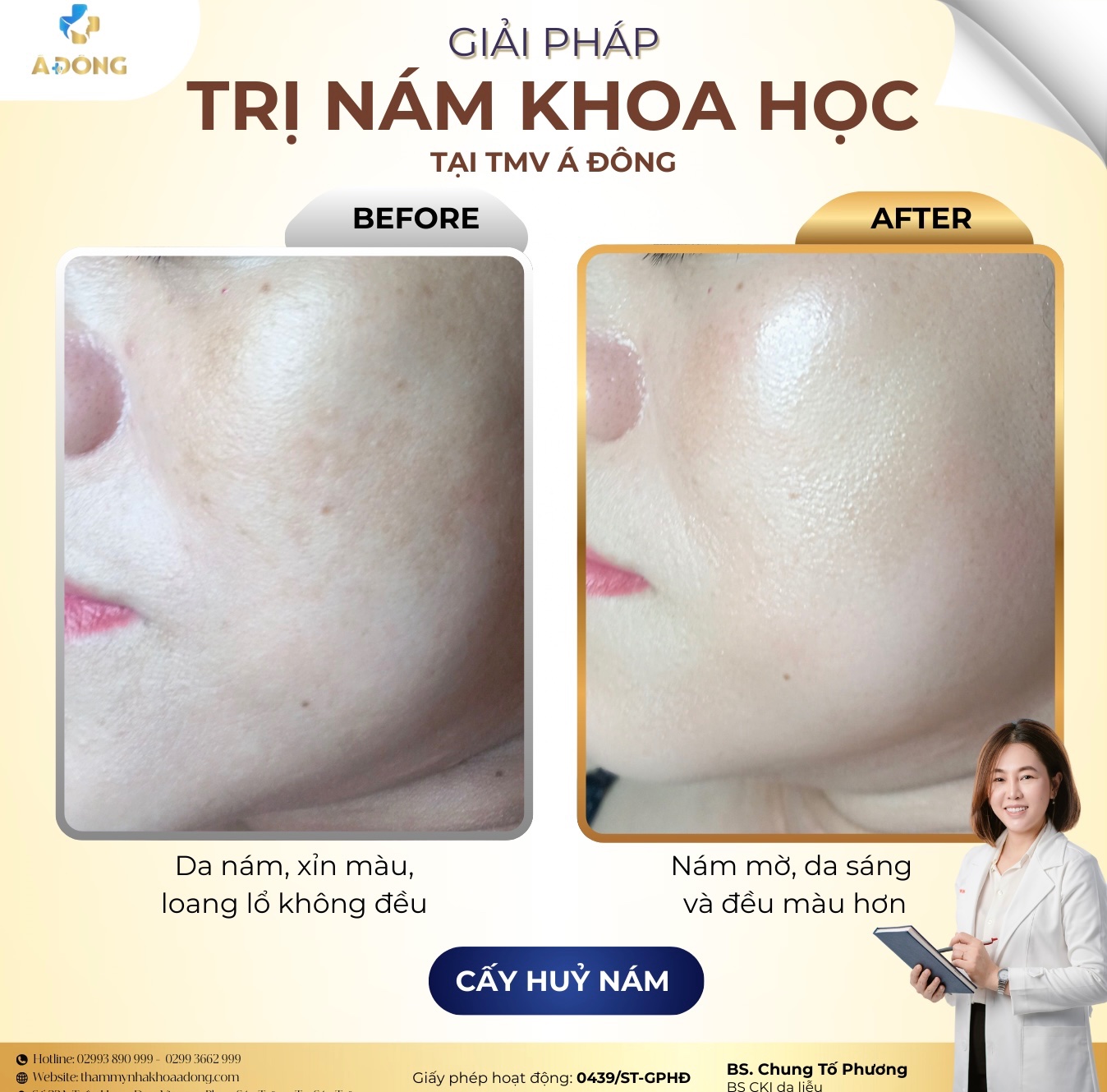 ✨ GIẢI PHÁP CẤY HỦY NÁM KHOA HỌC – LẤY LẠI LÀN DA ĐỀU MÀU, RẠNG RỠ ✨