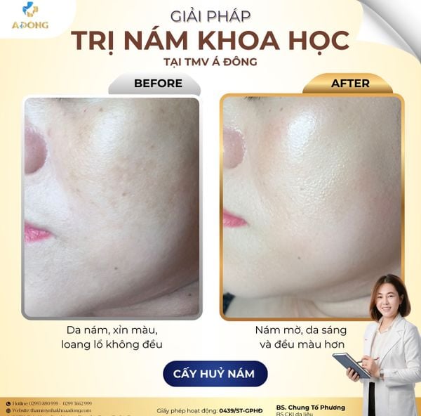 ✨ GIẢI PHÁP CẤY HỦY NÁM KHOA HỌC – LẤY LẠI LÀN DA ĐỀU MÀU, RẠNG RỠ ✨