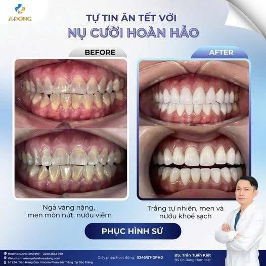 🌸🧧 ƯU ĐÃI TẾT – LÀM RĂNG ĐẸP, ĐÓN LỘC XUÂN 🧧🌸 #799K