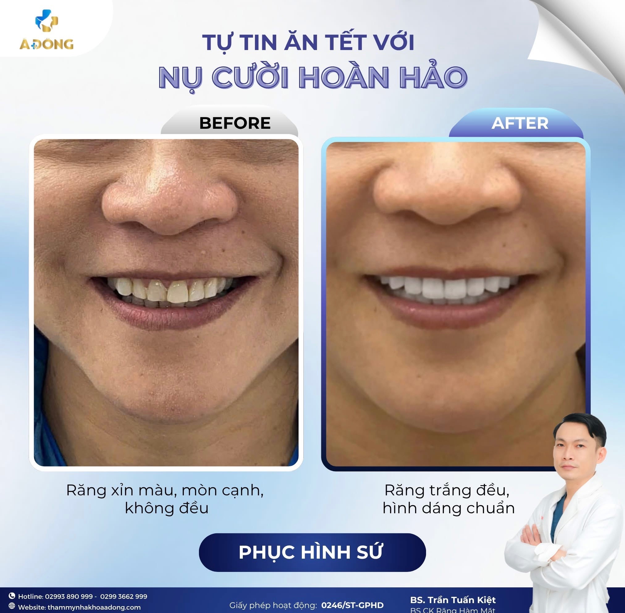 🪞 “Bọc sứ chỉ để đẹp?” – Sai lầm khiến nhiều người trả giá bằng sức khỏe