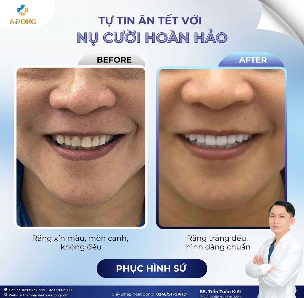 🪞 “Bọc sứ chỉ để đẹp?” – Sai lầm khiến nhiều người trả giá bằng sức khỏe