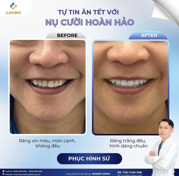 🪞 “Bọc sứ chỉ để đẹp?” – Sai lầm khiến nhiều người trả giá bằng sức khỏe