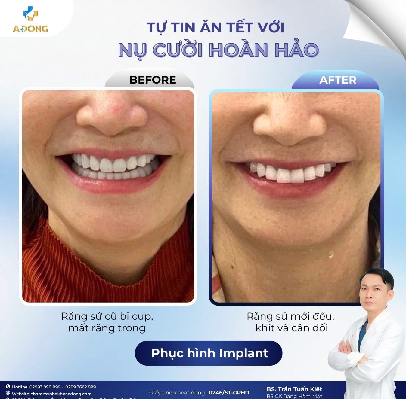 ✨ TỰ TIN ĂN TẾT VỚI NỤ CƯỜI HOÀN HẢO ✨