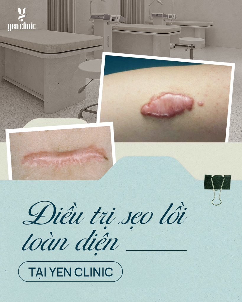 YEN CLINIC – TIÊN PHONG TRONG ĐIỀU TRỊ SẸO LỒI TOÀN DIỆN TẠI VIỆT NAM