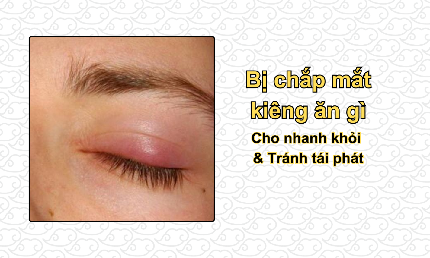 Bị chắp mắt kiêng ăn gì cho nhanh khỏi & tránh tái phát