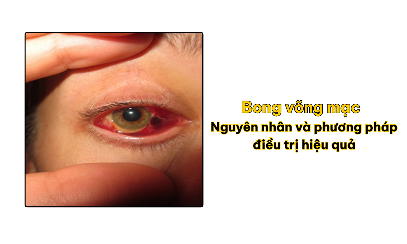 Bong võng mạc là gì? Nguyên nhân và phương pháp điều trị hiệu quả