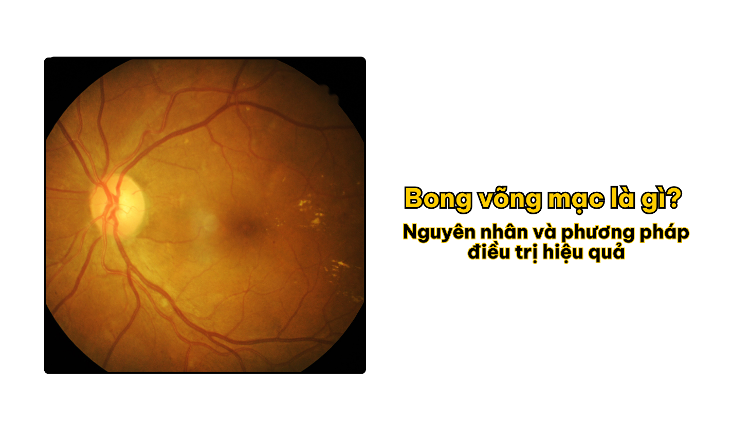 Bong võng mạc là gì? Nguyên nhân và phương pháp điều trị hiệu quả