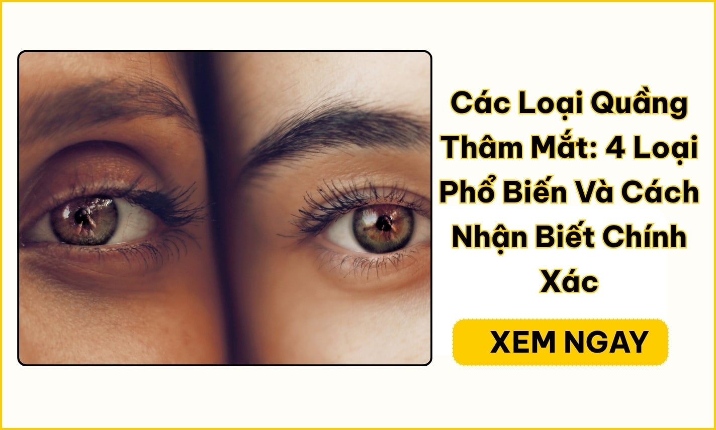 Các loại quầng thâm mắt: Cách phân biệt 4 nhóm thường gặp