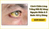 Cách Chữa Lòng Trắng Mắt Bị Vàng: Nguyên Nhân & 5 Bước Xử Lý Đúng