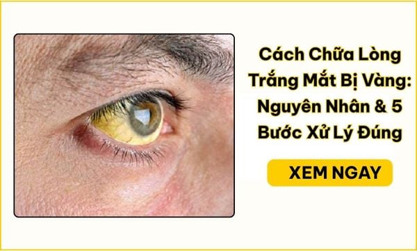 Cách chữa lòng trắng mắt bị vàng: 5 bước xử lý đúng