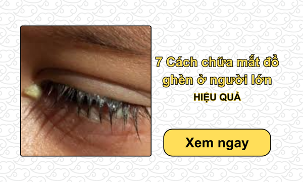 7 Cách chữa mắt đổ ghèn ở người lớn HIỆU QUẢ