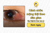 Cách chữa mộng thịt theo dân gian: Sự thật & Các lưu ý