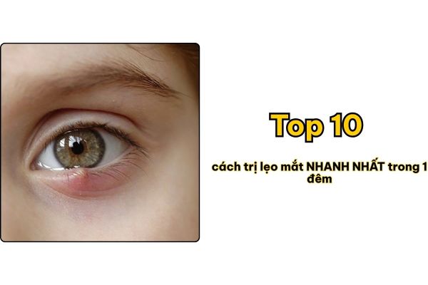 Top 10 cách trị lẹo mắt NHANH NHẤT trong 1 đêm