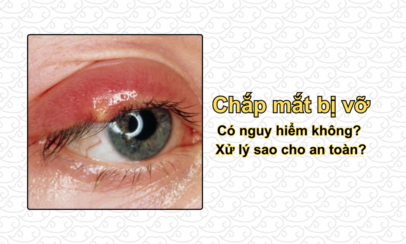Chắp mắt bị vỡ có nguy hiểm không? Xử lý sao cho an toàn?