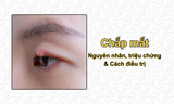 Chắp mắt: Nguyên nhân, triệu chứng & Cách điều trị