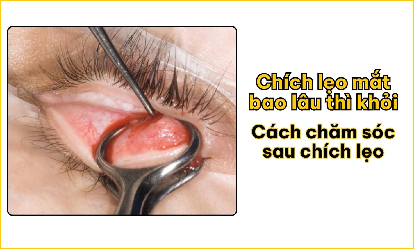 Chích lẹo mắt bao lâu thì khỏi? Quy trình & chăm sóc sau chích
