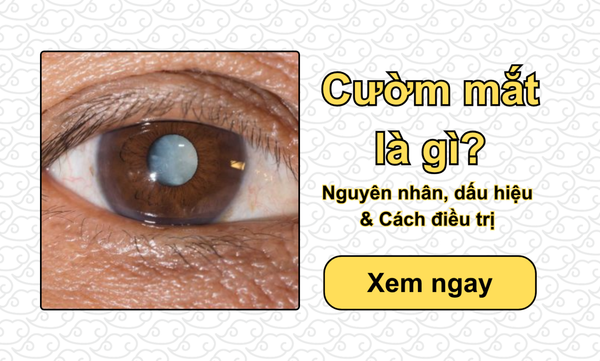 Cườm mắt là gì? Nguyên nhân, dấu hiệu & Cách điều trị