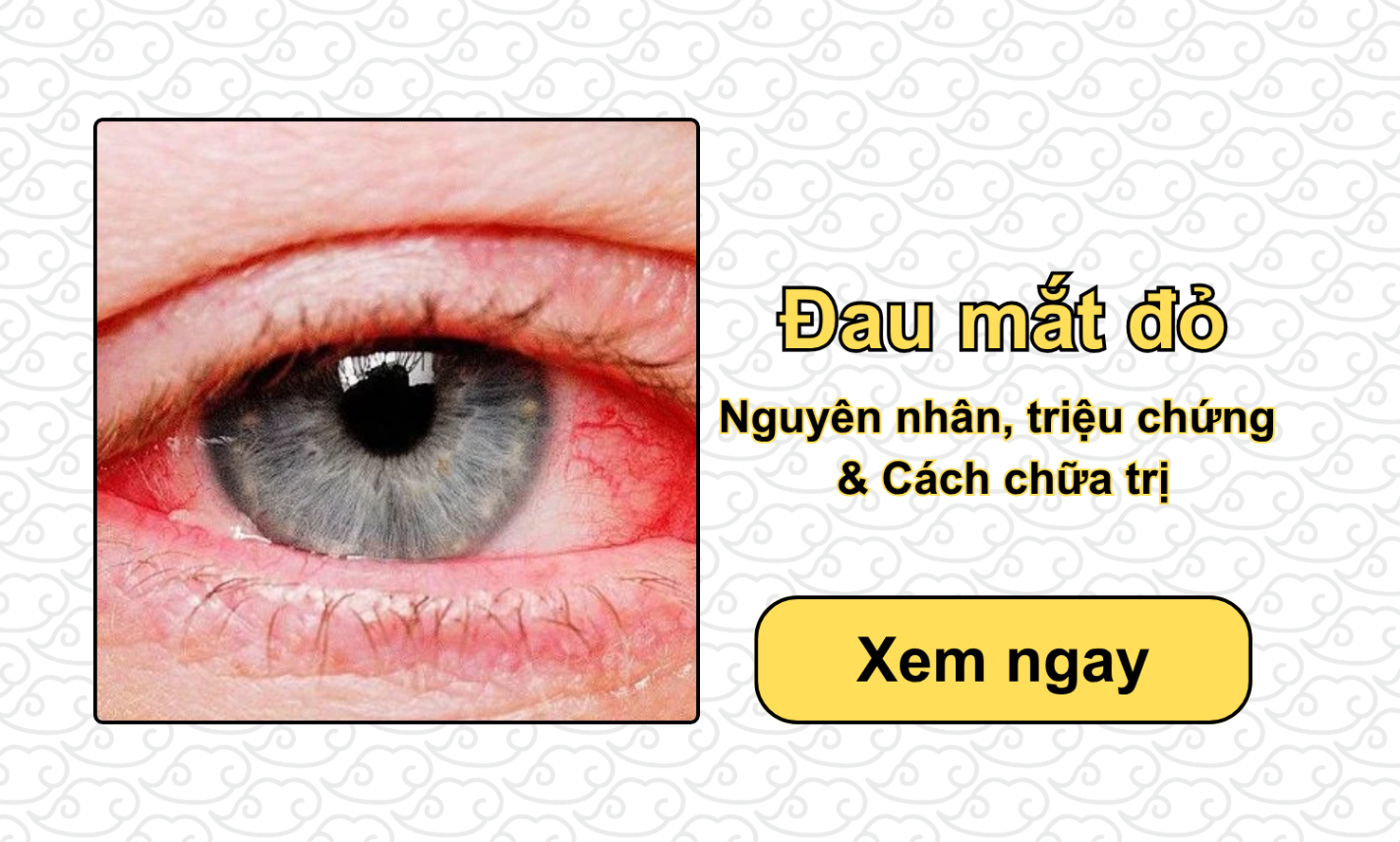 Đau mắt đỏ: Nguyên nhân, triệu chứng & Cách chữa trị