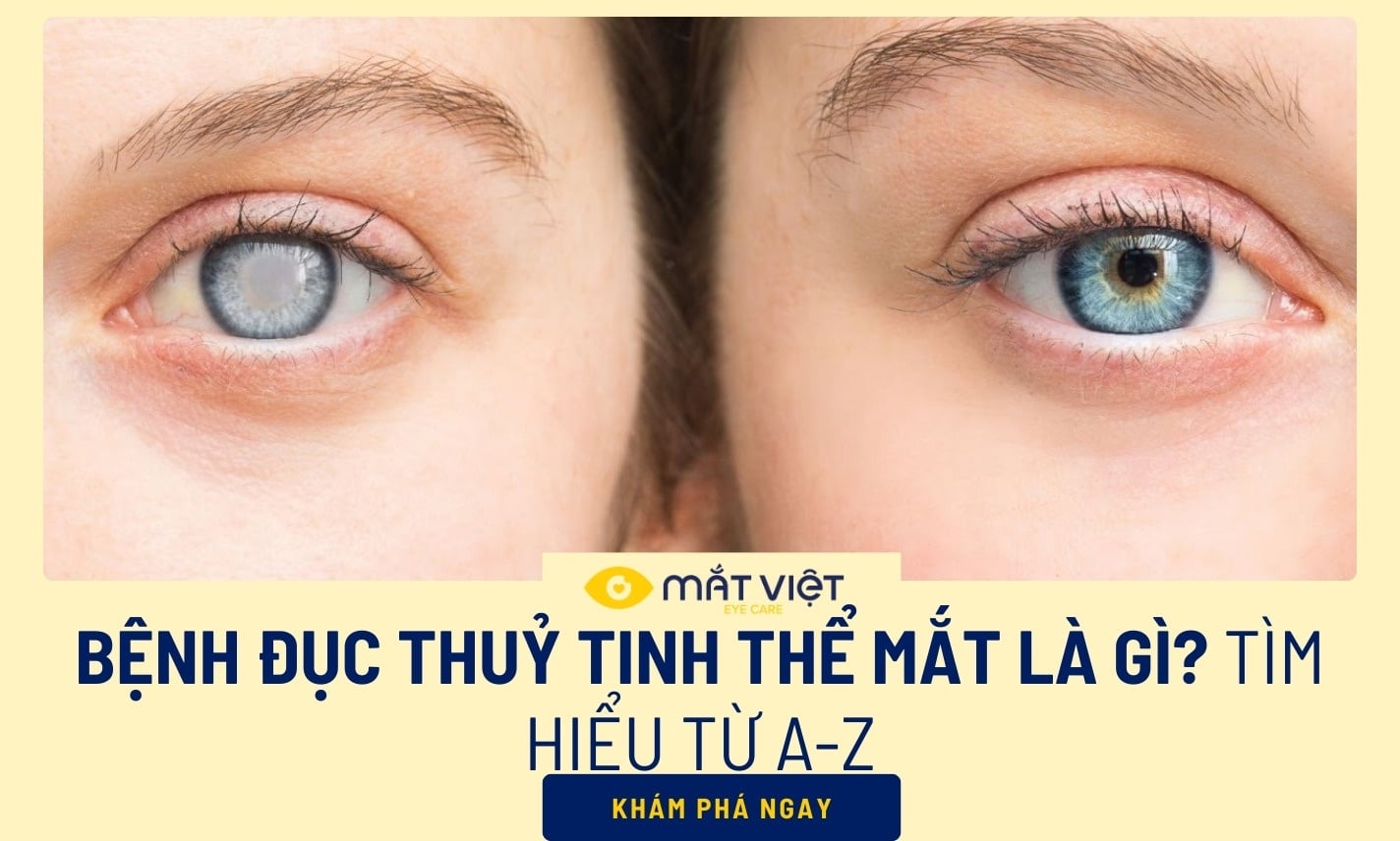 Bệnh đục thuỷ tinh thể mắt là gì? Tìm hiểu từ A-Z