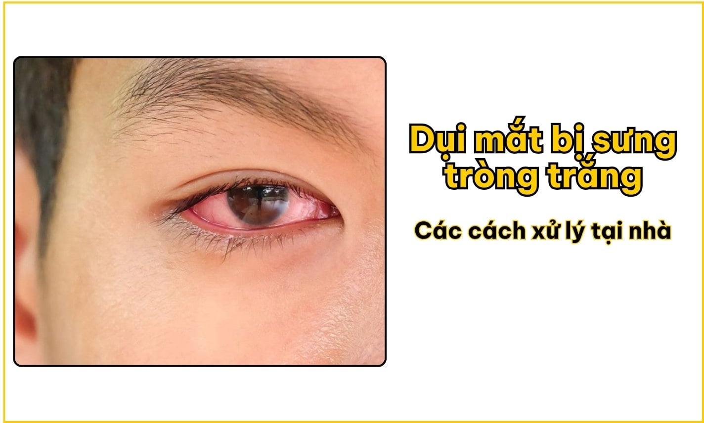 Dụi mắt bị sưng tròng trắng và các cách xử lý tại nhà