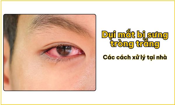 Dụi mắt bị sưng tròng trắng và các cách xử lý tại nhà